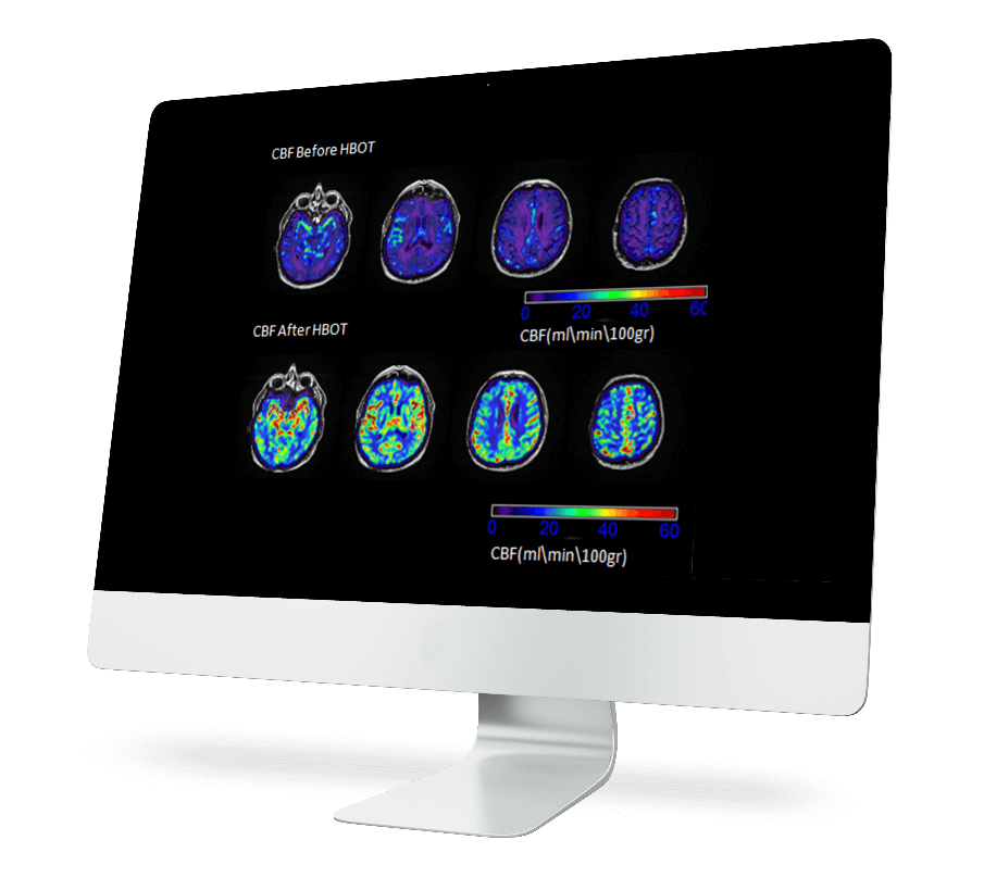 Benefits Hyperbaric Oxygen Therapy for Stroke Recovery