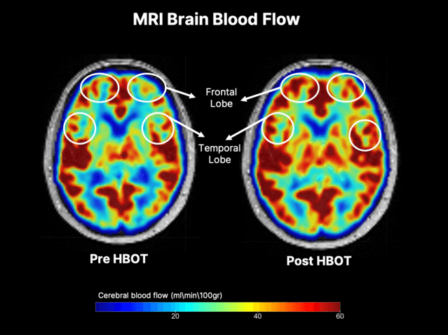 Hyperbaric oxygen treatment improves cognition